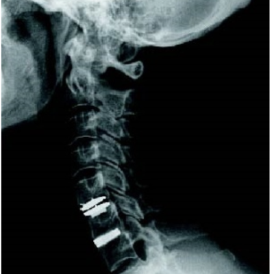 Columna Cervical